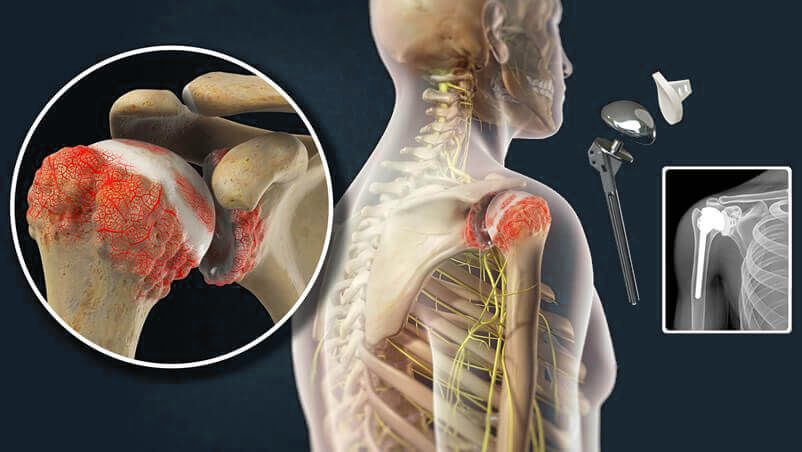 durere și roșeață a genunchilor tratamentul osteocondrozei sacrale